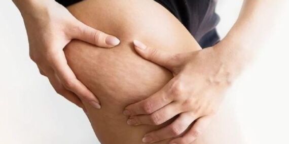 Evde selülit tedavisi: Mutfaktan gelen güzellik sırları!