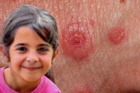 Narin Güran'ın otopsi işlemi tamamlandı! Peki lezyon nedir Lezyon nasıl oluşur