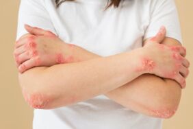 Doğal şifa kaynağı Elleri ayakları yumuşacık yapıyor! Egzama, mantar ve nasır sorununa doğal çözüm