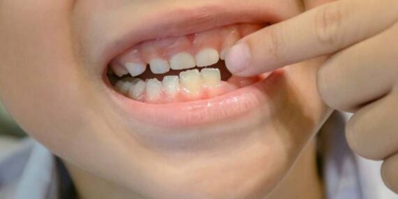 Rüyada diş dökülmesi görmek ne anlama geliyor? İşte rüya tabirlerine göre yorumlar