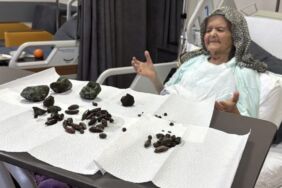 Doktorları şaşkına çevirdi 92 yaşındaki kadının midesinden çıkanlar şoke etti