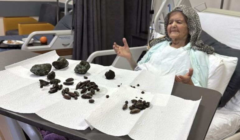 Doktorları şaşkına çevirdi 92 yaşındaki kadının midesinden çıkanlar şoke etti