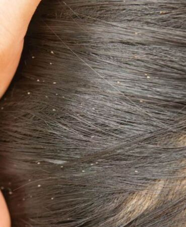 Saç biti neden oluşur Saç biti nasıl geçer Bit ve sirke için en etkili doğal çözüm nedir