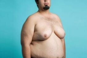 Erkeklerde kadın tipi meme büyümesi neden olur Tedavi yöntemleri nelerdir Uzmanı açıkladı
