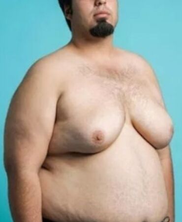 Erkeklerde kadın tipi meme büyümesi neden olur Tedavi yöntemleri nelerdir Uzmanı açıkladı