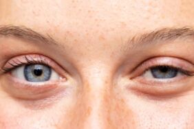 Göz Kapağı Düşüklüğüne Dikkat! Görme Kaybına Kadar Götürebilir