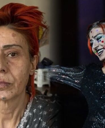 Yıldız Tilbe’den sağlık durumu hakkında yeni açıklama! Saç boyası yanığı sonrası son halini paylaştı