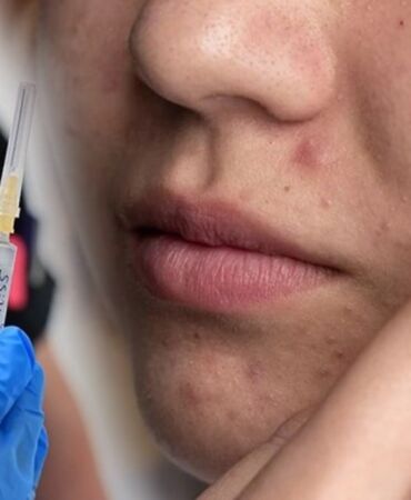 Akne tedavisinde yeni bir çağ başlıyor!