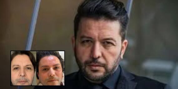 Nihat Doğan’ın estetik sonrası yeni hali olay yarattı!