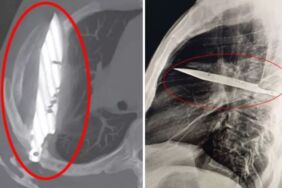 8 yıldır taşıdığı bıçağı ağrı sandı