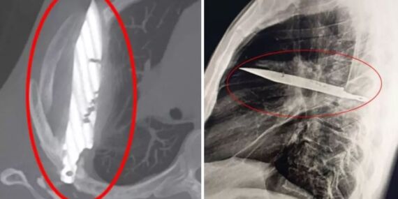 8 Yıldır göğüsünde taşıdığı bıçağı ağrı sandı!