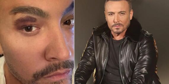 Cenk Eren sahnede kaza geçirdi: Mikrofon kaşını patlattı!