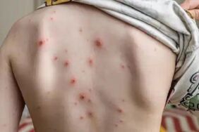 Uzmanlardan ailelere uyarı Suçiçeği döküntüden önce bulaşıyor!