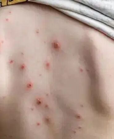 Uzmanlardan ailelere uyarı Suçiçeği döküntüden önce bulaşıyor!