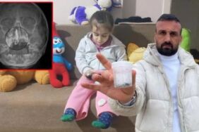 Şiddetli burun kanaması yaşıyordu... 5 yaşındaki Polen'in burnundan tırnak makası zinciri çıktı!