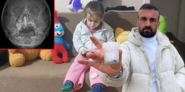 Şiddetli burun kanaması yaşıyordu... 5 yaşındaki Polen'in burnundan tırnak makası zinciri çıktı!