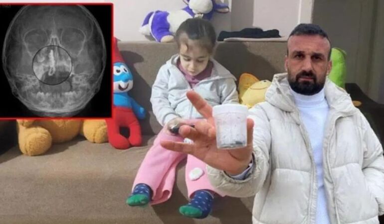 Şiddetli burun kanaması yaşıyordu... 5 yaşındaki Polen'in burnundan tırnak makası zinciri çıktı!