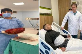 Karnından 8 kiloluk böbrek çıkarıldı