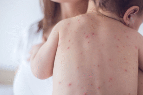 Kızamıkta gizli tehlike Döküntüyle sınırlı değil, ölümcül risk de taşıyor