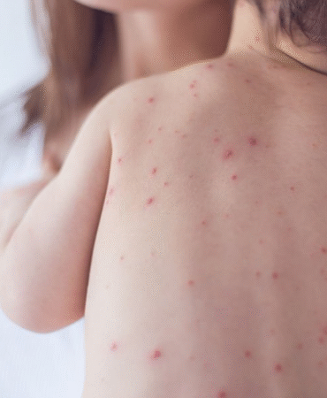 Kızamıkta gizli tehlike Döküntüyle sınırlı değil, ölümcül risk de taşıyor