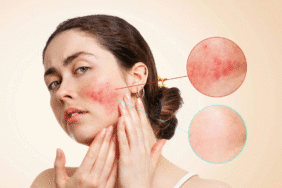 Yüzdeki kızarıklık ve yanmayı hafife almayın Gül hastalığının belirtileri olabilir